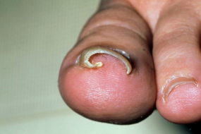 ingrown nail treatment