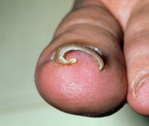 ingrown nail treatment