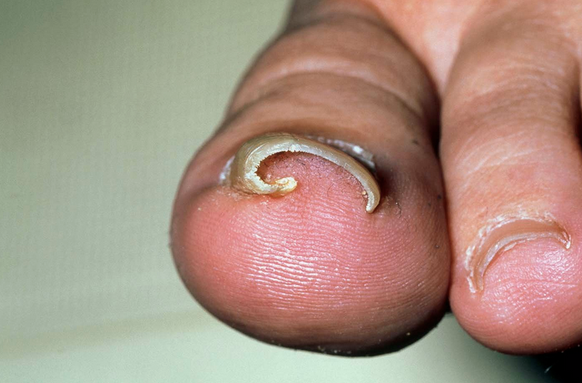 ingrown nail treatment