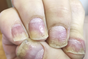 nail psoriasis treatment