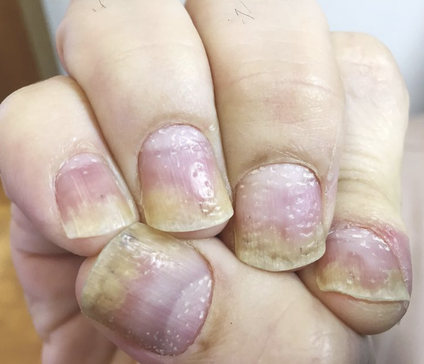 nail psoriasis treatment