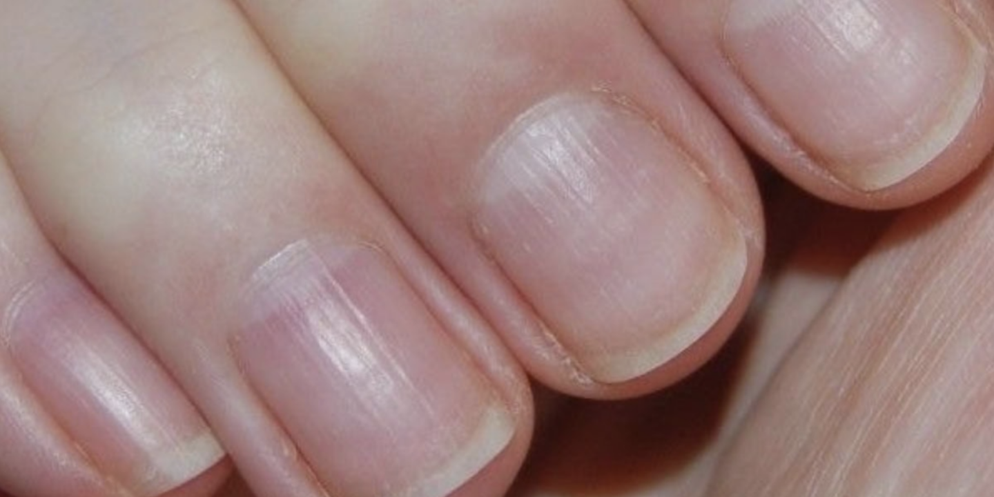 nail ridges treatment