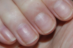 nail ridges treatment