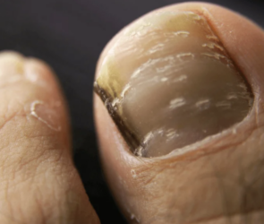 risks-and-complications-of-untreated-toe-fungus