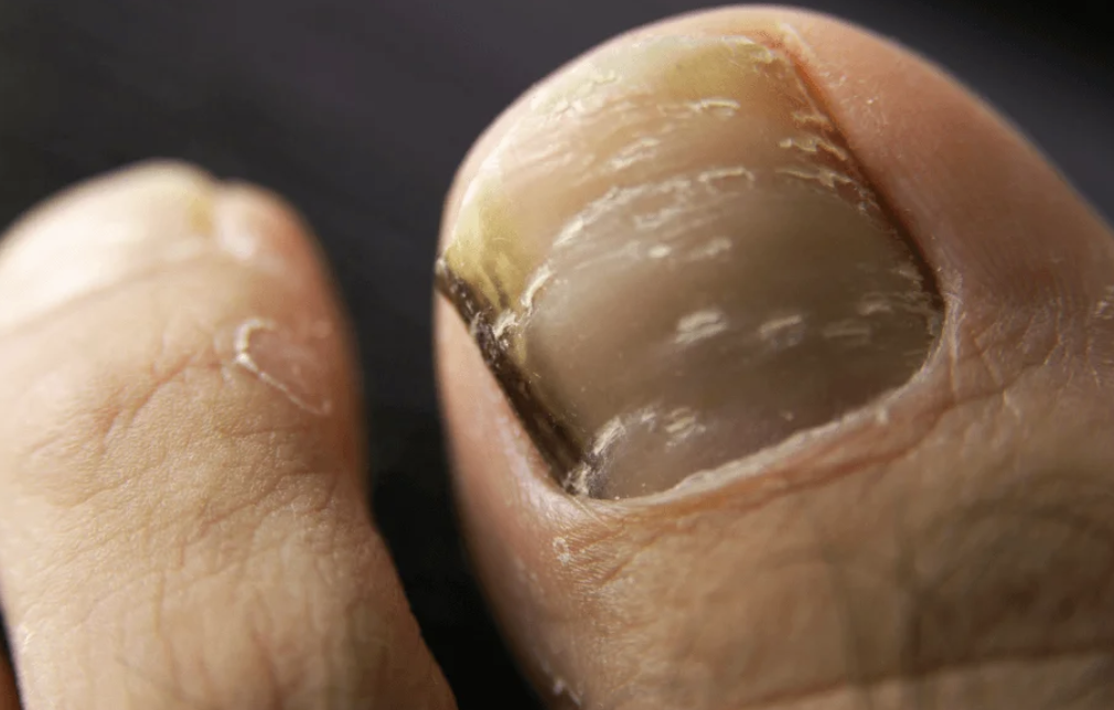 risks-and-complications-of-untreated-toe-fungus