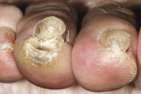 toe fungus