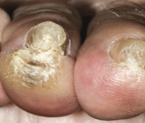 toe fungus