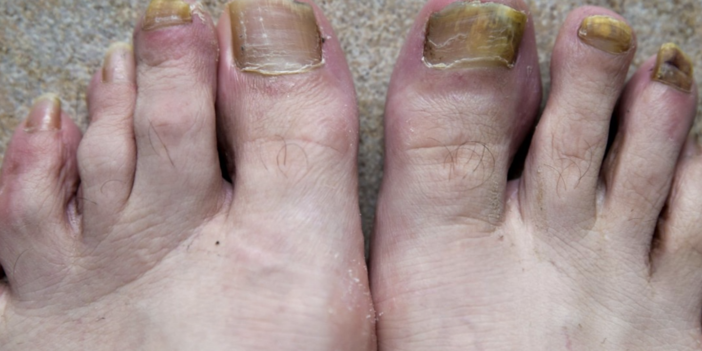 toe-fungus-diagnosis