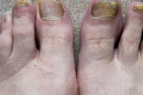 toe-fungus-diagnosis