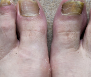 toe-fungus-diagnosis