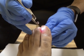 toe fungus laser treatment