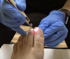 toe fungus laser treatment
