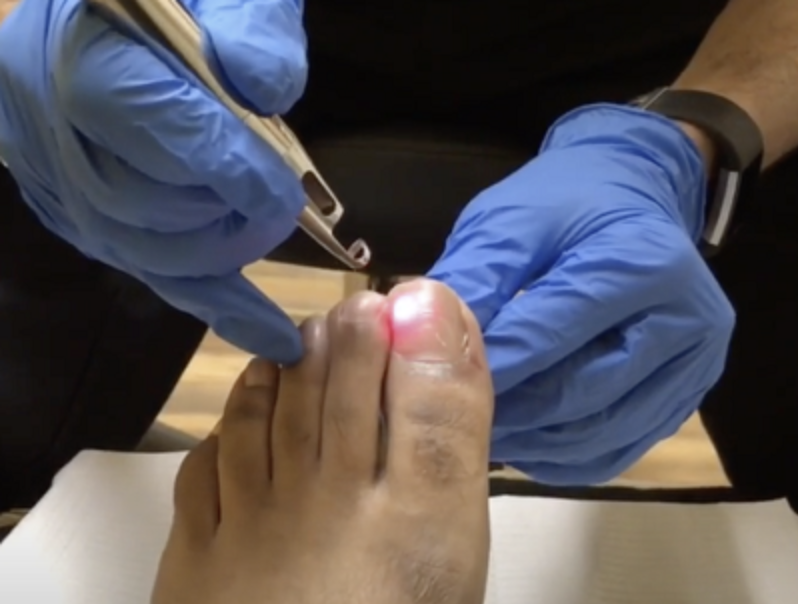 toe fungus laser treatment