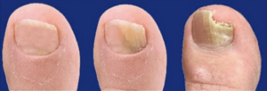 toe fungus stages