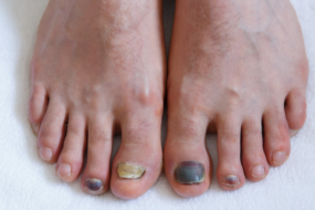 toe fungus vs other foot conditions