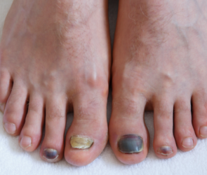 toe fungus vs other foot conditions
