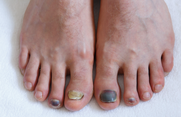 toe fungus vs other foot conditions