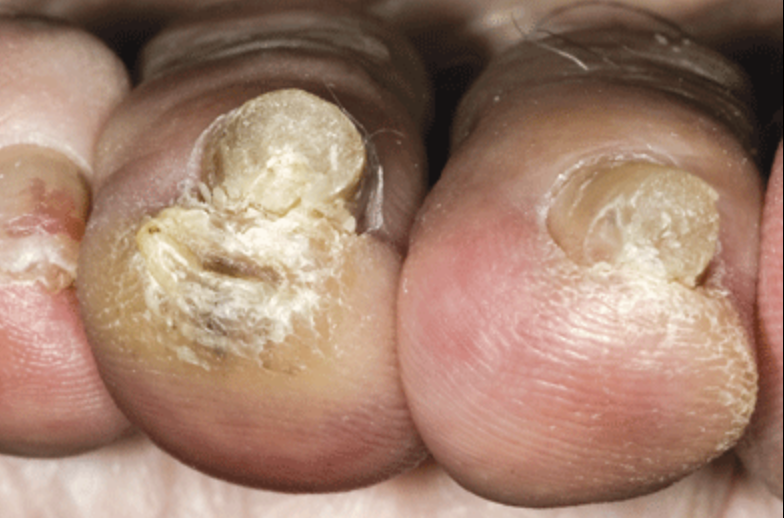 toe fungus