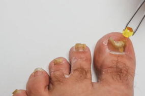 toe nail fungus tea tree oil