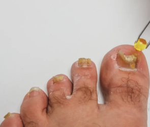 toe nail fungus tea tree oil