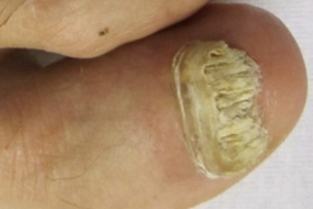 what causes toe fungus