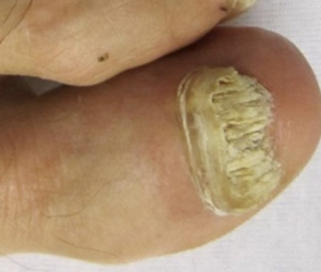 what causes toe fungus