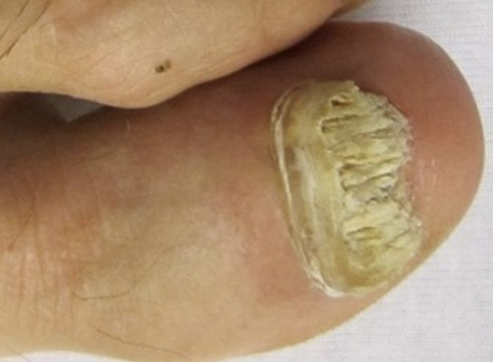 what causes toe fungus