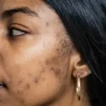 Conquering Acne Scars: Advanced Removal Techniques Revealed 9 Conquering Acne Scars