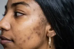 Conquering Acne Scars: Advanced Removal Techniques Revealed 2 Conquering Acne Scars