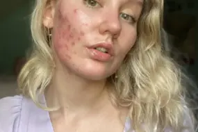 How Diet Transforms Acne: 2026 Science-Backed Insights 5 How Diet Transforms Acne