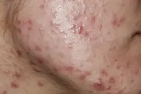 Strategic Skincare: 9 Proven Steps to Prevent Acne Flare-Ups 3 Prevent Acne Flare-Ups