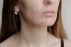 Types of Acne Explained: Comprehensive Classification & Ultimate Guide for Clear Skin 4 Types of Acne