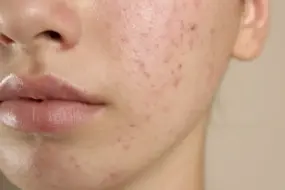 Ultimate 2026 Acne Treatment Guide | Transform Your Skin & Clear Acne Fast 3 Acne