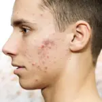 Teen Acne Solutions: 5 Proven Tips for Clear, Youthful Skin 8 acne in teenagers