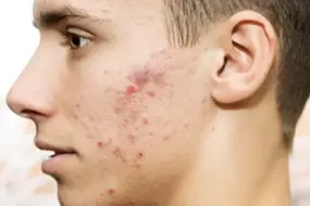 Teen Acne Solutions: 5 Proven Tips for Clear, Youthful Skin 4 acne in teenagers