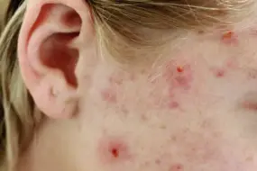 7 Proven Acne Treatments Dermatologists Swear By 5 acne treatment