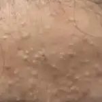 Comedonal Acne: Understanding Blackheads and Whiteheads 3 comedonal acne