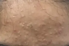 Comedonal Acne: Understanding Blackheads and Whiteheads 5 comedonal acne