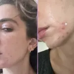 Hormonal Acne: Causes, Treatments, and Hormone Therapy 6 hormonal treatment of acne