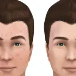 Inflammatory vs Non-Inflammatory Acne: Key Differences Explained for Clear Skin 2 inflammatory vs non-inflammatory acne