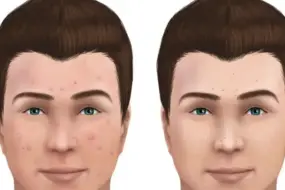 Inflammatory vs Non-Inflammatory Acne: Key Differences Explained for Clear Skin 5 inflammatory vs non-inflammatory acne