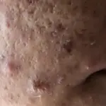 Nodular Acne Treatment: Causes, Symptoms & Best Solutions for Clear Skin 1 nodular acne