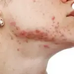 Major Causes of Common Pimples: Acne Types, Triggers & Treatment Tips 4 causes types of pimples