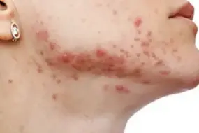 Major Causes of Common Pimples: Acne Types, Triggers & Treatment Tips 2 causes types of pimples